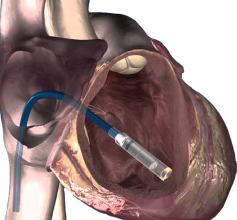 βηματοδοτης