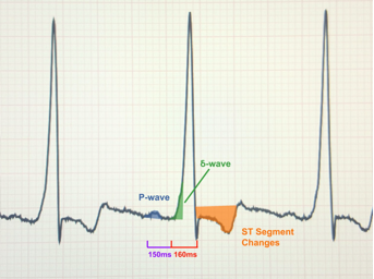Σύνδρομο WPW 1