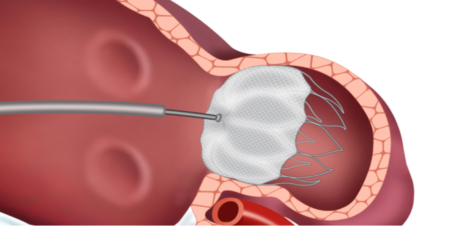 σύγκλειση ωτίου